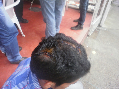 José Melco Rodríguez Soria, campesino de Rioblanco (Tolima), brutalmente agredido por el Esmad y la Policía nacional. Fotos Nelosi